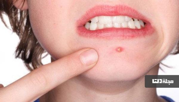 جلوگیری از جوش صورت در خانه جلوگیری از جوش صورت در خانه